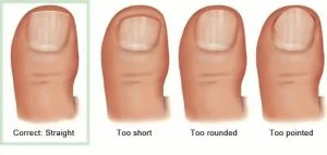 Ingrown toenail prevention