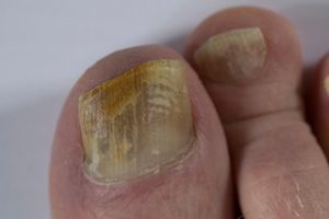 Fungal Nails In runners