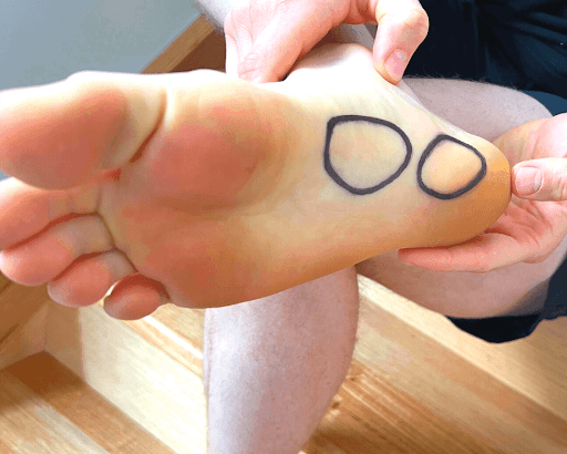4 Sign You Might Have Plantar Fasciitis